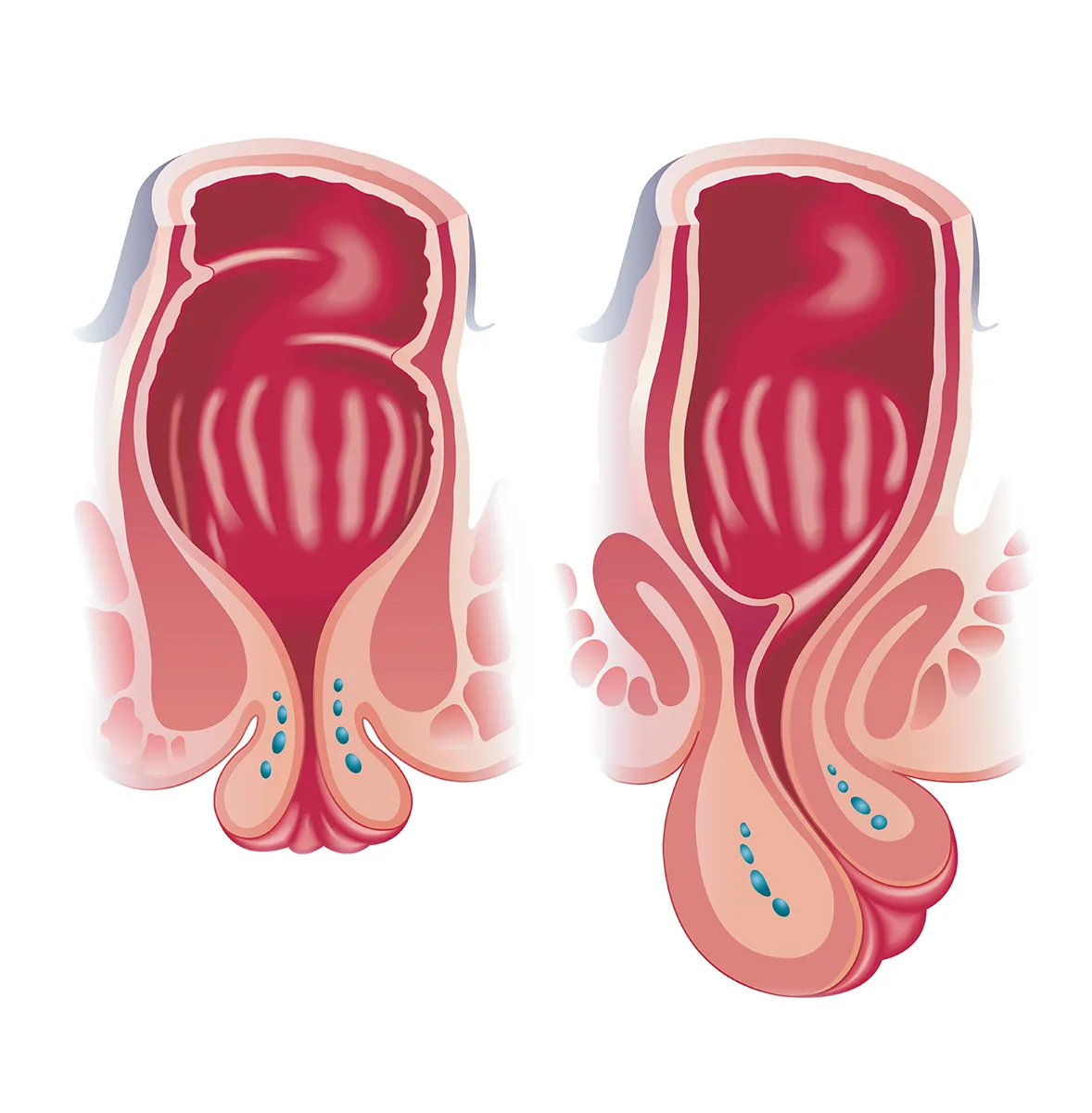 illustration prolapsus rectal