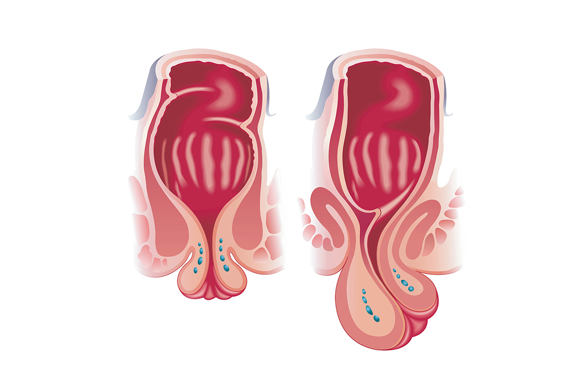 prolapsus rectal CAPP